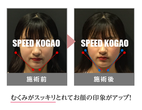 公式】Speed小顔（スピード小顔） | 多数のモデル・芸能人さんも通う小