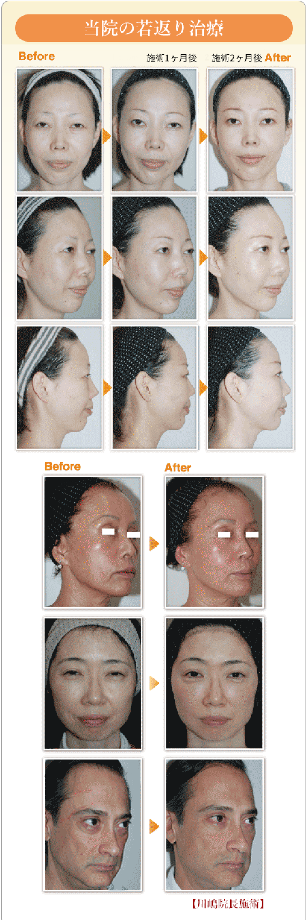 サーマフラクショナル リフトアップサーマクール高周波ラジオ波