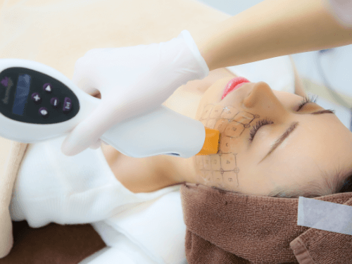 サーマクール（ThemaCool）でたるみ改善・小顔効果｜サーマクールなら