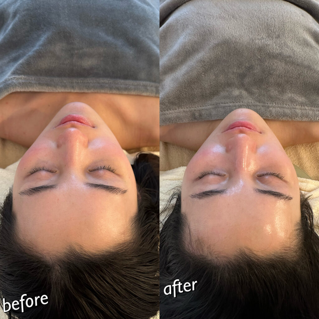 ダイヤモンドチップ 水光 ラジオ波 冷却 高周波 水光注射 針なし