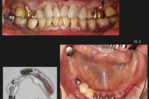 長い遊離端欠損に対峙したもの③｜お知らせ | 早田歯科医院