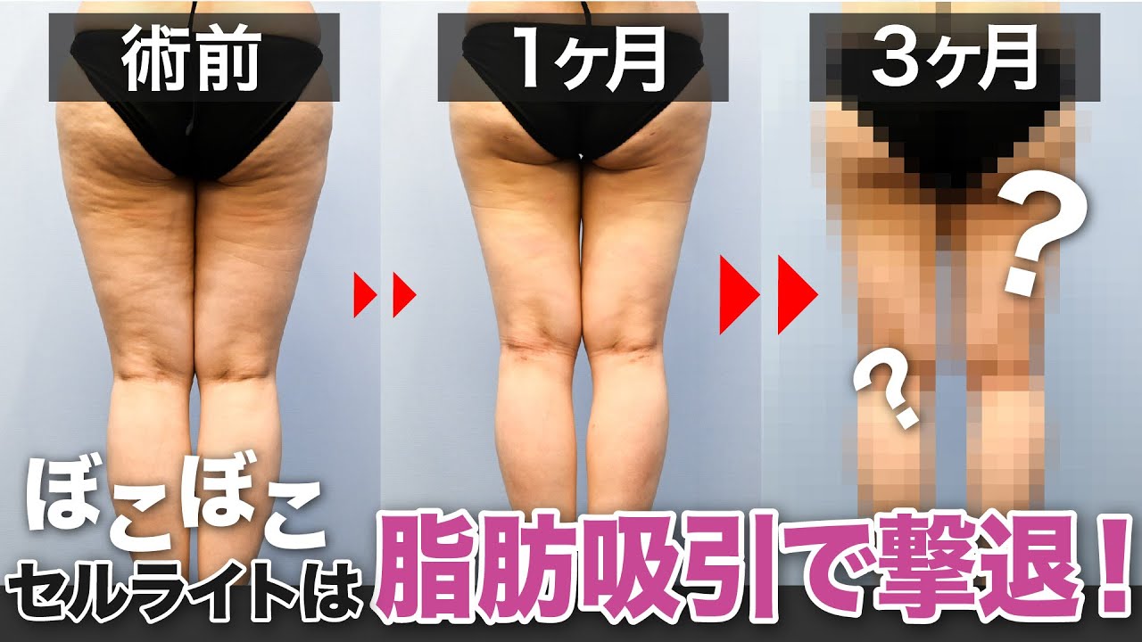 セルライト除去】究極の足痩せするならやっぱり脂肪吸引 パルバスター