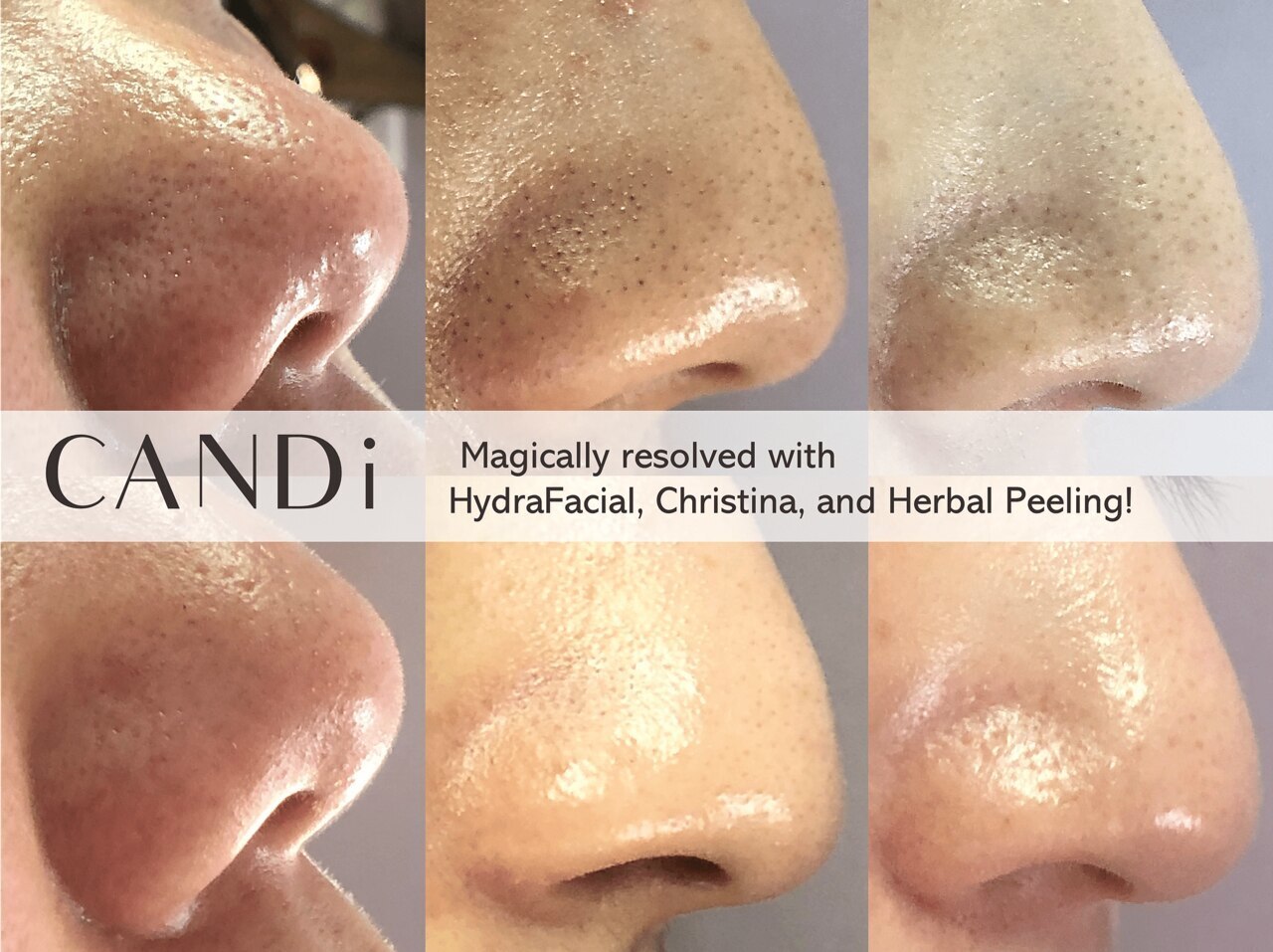 中古⁄美品6in1ハイドラフェイシャル 毛穴洗浄 角質除去 エステ⁄業務