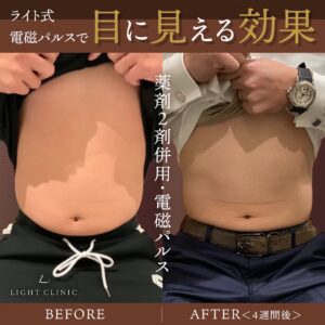 電磁パルスでぽっこりお腹を撃退！｜梅田・名古屋の医療ダイエット専門