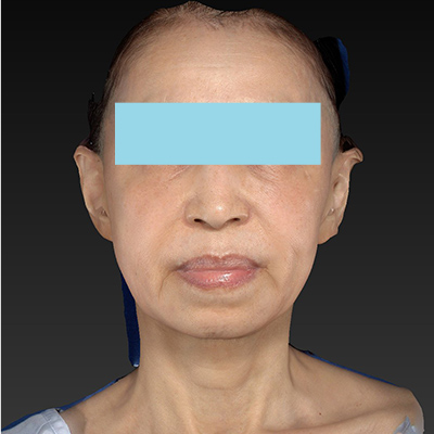 60代女性 | 切るリフトアップによるフェイスラインのたるみ改善 | 新宿