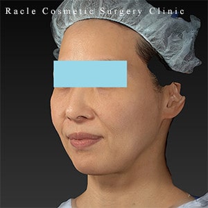 サーマクールFLX(切らないたるみ治療) | 新宿ラクル美容外科クリニック