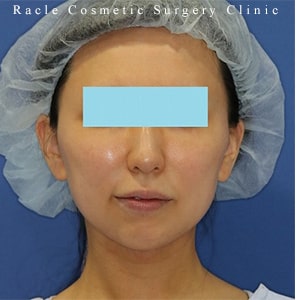 サーマクールFLX(切らないたるみ治療) | 新宿ラクル美容外科クリニック