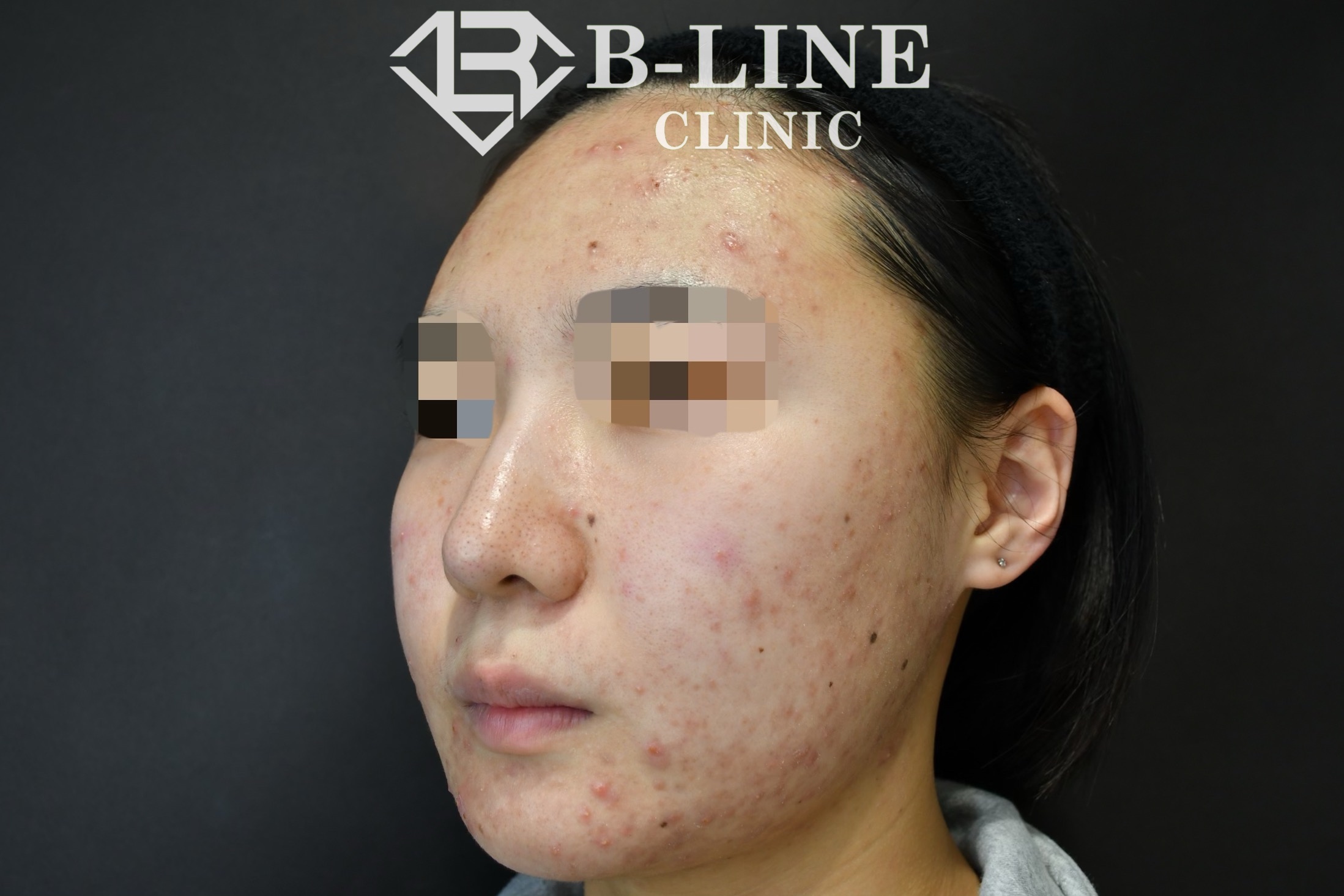 2023年最新エレクトロポレーション ハイドラフェイシャル 2023年最新