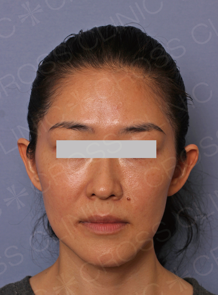 サーマクールFLX｜美容皮膚科のクロスクリニック銀座