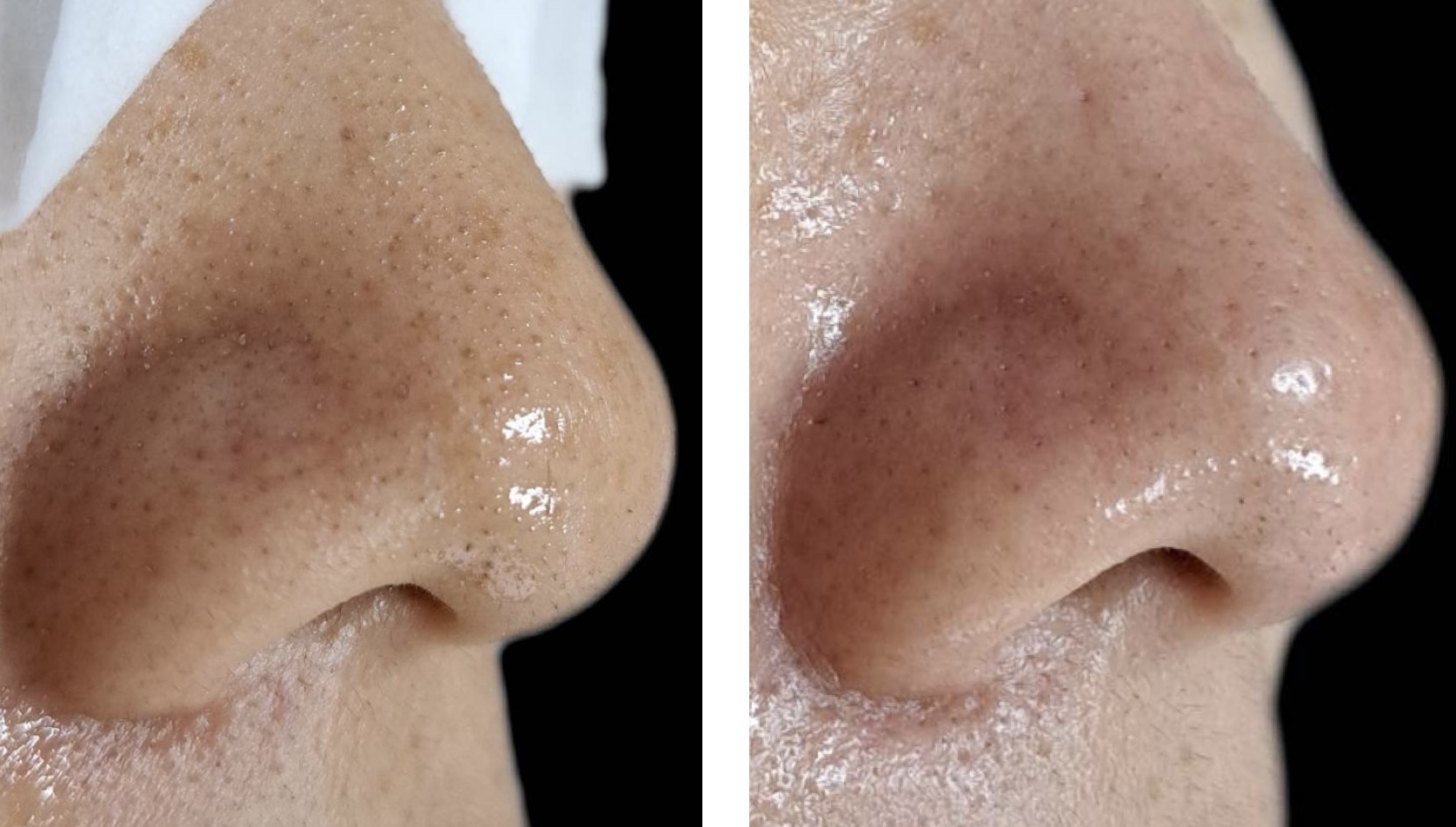 プラズマシャワー・ハイドラフェイシャル・フェイスリフト・毛穴