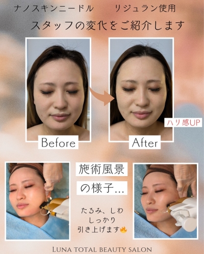 ナノスキンニードル/水光ジェット／高圧ジェット レモンボトル5本付